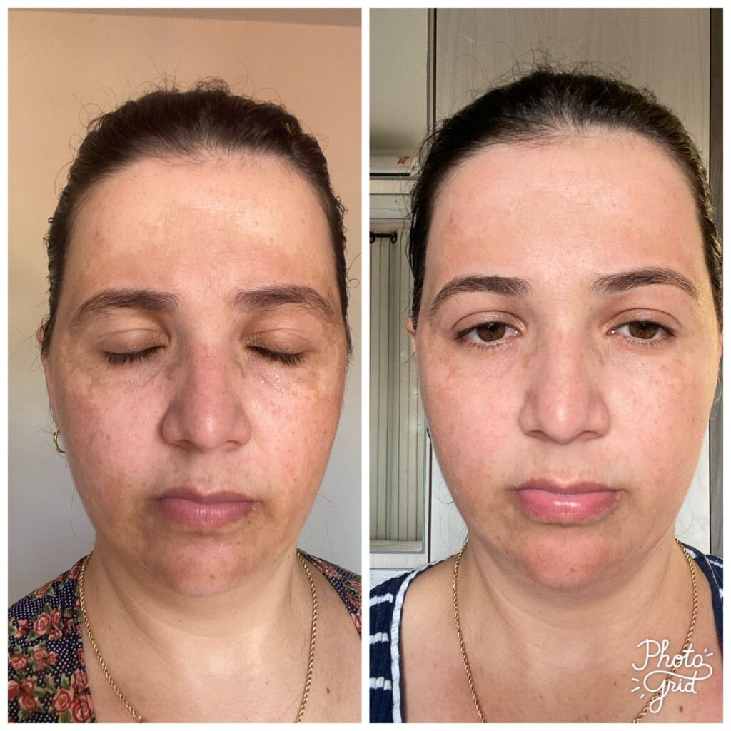 Antes e depois de tratamento para melasma em paciente