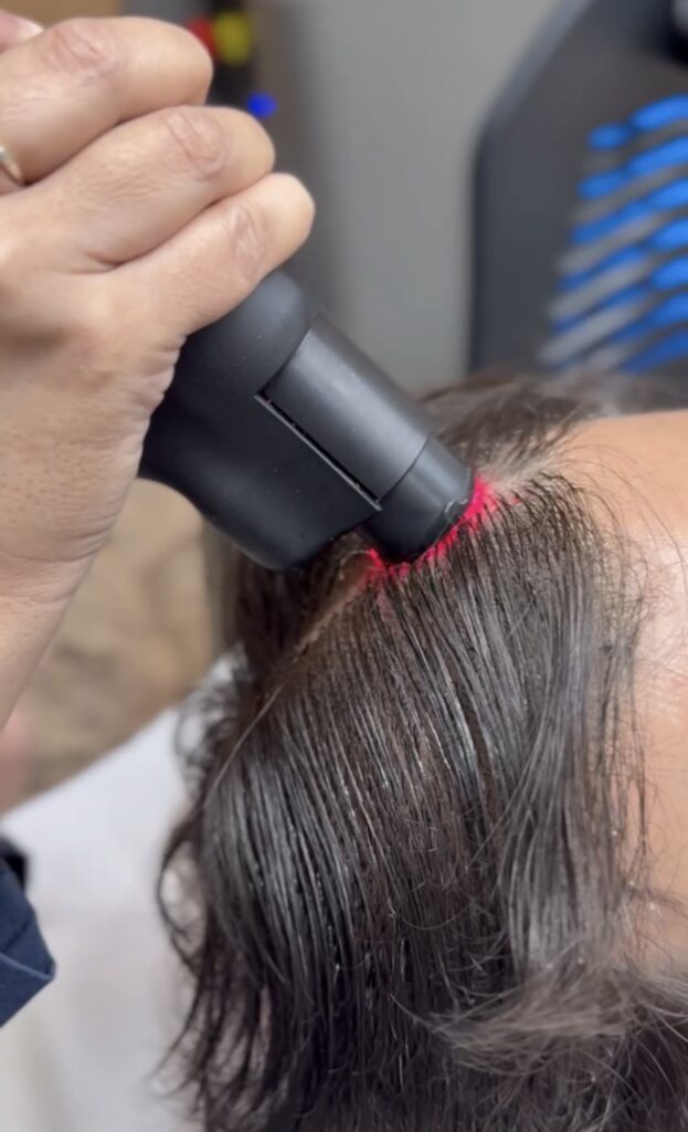 Tratamento capilar feito com o Laser RedTouch