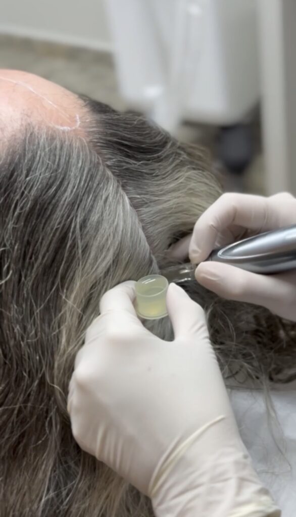 A Microinfusão de Medicamentos na Pele, conhecida como MMP