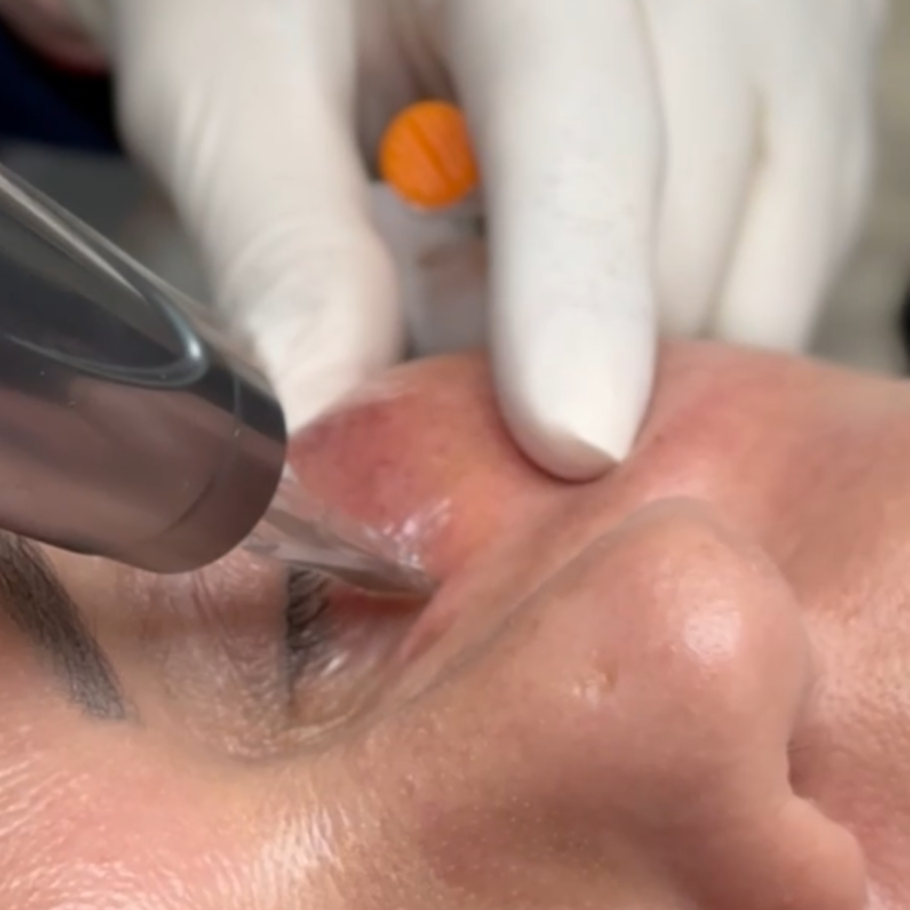 procedimento-dermatologico-facial-associado-a-tecnologias-regenerativas